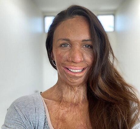 Turia Pitt