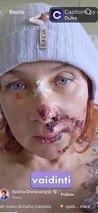 Redita Dominaitytė patyrė traumą